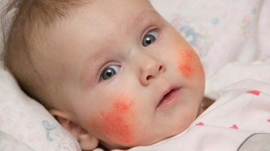 ¿Existe relación entre la enfermedad infantil de Kawasaki y el coronavirus?